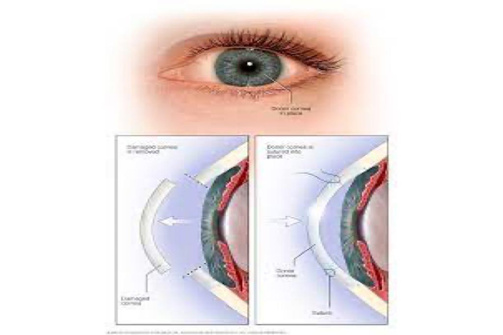 Cornea Surgery